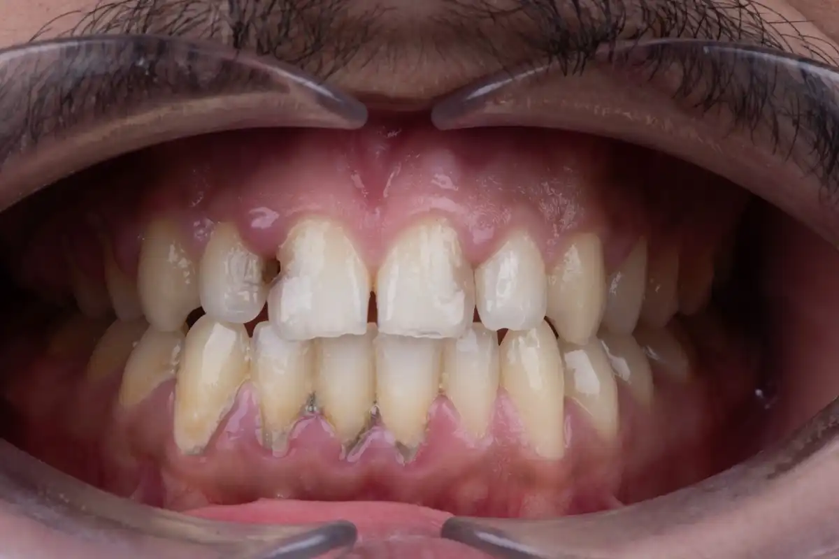 Dopo faccetta dentale Tunisia prezzo accessibile – sorriso trasformato VIP Smile